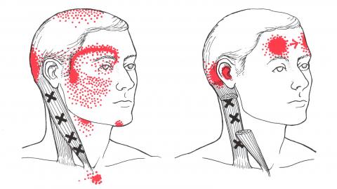 Myofascial Trigger Points Chart